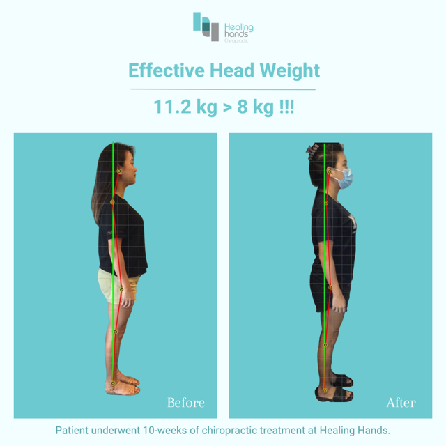 Chiropractic Before and After - Headache and Neck Pain