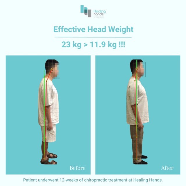 Chiropractic Before and After - Neck and Back Pain