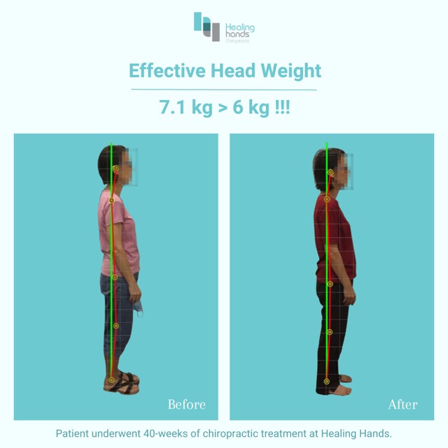 Chiropractic Before and After - Chronic Headache