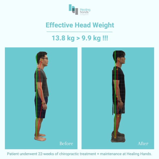 Chiropractic Before and After - Back Pain and Shoulder Stiffness