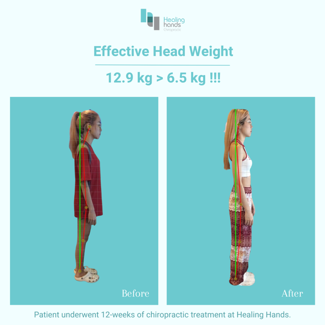 Chiropractic Before and After - Chronic Headache and Neck Pain